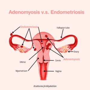 Adenomyosis The Difference